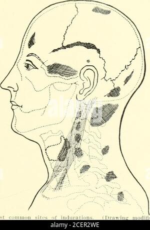 . Contributi del Dipartimento di Neurologia e del laboratorio di Neuropatologia (ristampe). 3. Indurimento. Vi è un'assenza di elasticitàe l'organizzazione ha fatto avanzare alla fase in cui l'asubstance della consistenza cartilaginea si presenta all'esaminatore. Più vecchi questi addensamenti sono il primeressi sono diventati e più resistenza offrono il totreatment. Queste indurazioni appaiono ancora e ancora per qualche tempo prima di diventare croniche, e non sono affatto 4. Mitrholl : Ri-lalion nf Neurnlgic Hoadache alle tempeste, Tr. Collana Iliys. Philadelphia, 1003, xxv, 71 Foto Stock