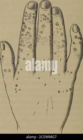 . Il manuale di riferimento pronto delle malattie della pelle. Cocaina, aconite e molte altre che volontariamente aboliscono la sensazione quando preso internamente. Il soggetto si alleva al dominio del neurologo. Tubercolo anatomico. Vedere tuberculosis verrucosa cutis. Angio-keratoma1 (AN2-gi-o-ker2-a2t-oma3) è il nome dato da Pringle ad una malattia particolare della pelle delle mani, dei piedi e delle orecchie, che è stato chiamato telangiectaticwarts o verrues telangiectasiques. Sintomi. Segue i chilblains e interessa gli aspetti dorsali di principio delle mani e dei piedi, benchè la loro plantarsurface può essere implicata ad a. Foto Stock