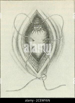 . Un manuale di gynæcology e chirurgia pelvica, per studenti e professionisti. Fig. 218.-ovariotomia. Quest'ultima parte di questa legatura può essere realizzata come sutura, una o due volte mentre circonda il pedicolo, e la sicurezza assoluta si ottiene prelevando e legando ogni nave dopo il principale OVARIOTOMY 433. Fig. 219.-ovariotomia. Le adesioni possono essere prevenute seppellendo lo stumpcon una sutura a filo di borsetta. Foto Stock