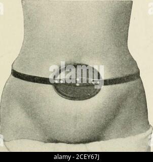 . Ernia addominale : diagnosi e trattamento. 13. Imbottitura in gomma extra dura, elastico ellissico e mano da utilizzare in combinazione con la cintura addominale. 14. Capriate ombelicali in gomma dura eUiptica-molla applicate. Foto Stock