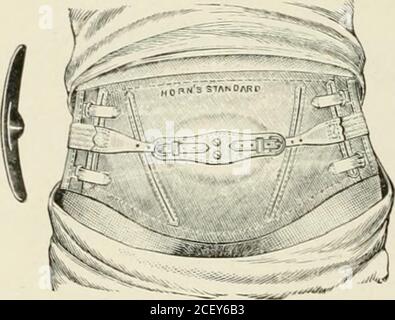 . Ernia addominale : diagnosi e trattamento. Maschere concave di gomma liliarda da utilizzare all'interno di i.it .ill.jin;lielts iial in ernia iiriducilile ombelicale. II. Cintura Combinalioa e tampone ombelicale. Foto Stock