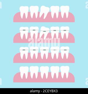 Correzione dei denti con le bretelle ortodontiche. Illustrazione del vettore di trattamento ortodontico del dente. Prima e dopo il concetto di correzione dei denti delle bretelle dentali Illustrazione Vettoriale