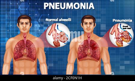 Confronto di alveoli sani e polmonite illustrazione Illustrazione Vettoriale