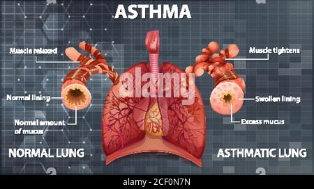 Confronto tra un'illustrazione polmonare sana e un'illustrazione polmonare asmatica Illustrazione Vettoriale