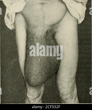 . Ernia addominale : la sua diagnosi e il suo trattamento. Carattere insolito (fig. 155). Questa mesen-tery era una massa a forma di ventaglio, a forma di tavola, completamente un pollice di spessore. Fig. 153.. Enormotis destra ernia scrotale in un uomo oltre 70 anni. Completamente riducibile ma non raggiungibile da qualsiasi capriolo che possa essere tollerato. Contenuto, intestino crasso e piccolo e piccola quantità di omentum. Avendo un feeliig un po' come quello di un denso, ampio tendine.al punto in cui è entrato nell'addome, è stato bunchedtogether in una massa grande come un avambraccio adulto, appena belowthe gomito, e apparentemente quasi come inflessibile. COMPILICATIO Foto Stock