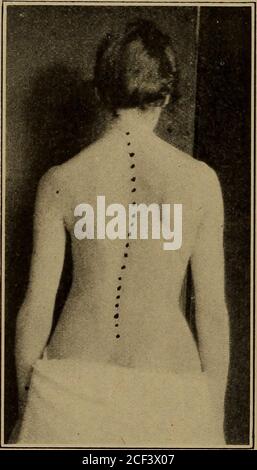 . Anatomia applicata e cinesiologia. Regione r. Questo addestrerà i flessori dell'anca per mantenere il bacino dal ribaltamento troppo indietro. Inclinando all'indietro non più di 30 gradi dalla posizione seduta dovrebbe aiutare nella sameway. I muscoli di hamstring sono adatti per essere un po 'shortenedand piegando tronco molto in avanti sarà di aiuto nel allungarli. La scoliosi o la curvatura laterale della colonna vertebrale è una deviazione della spespina lateralmente da una linea verticale diritta. La presenza di rota- 244 LA POSIZIONE ERETTA zione, che è stata spiegata in relazione ai movimenti del tronco, è una caratteristica importante e una Foto Stock