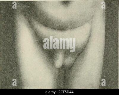 . Ernia addominale : diagnosi e trattamento. Carca! ernia. raramente esiste in altre forme di ernia. È impossibile decidere tra un sacco molto addensato e un'ernia che è solo parzialmente riducibile. Ci è un'altra indicazione importante che può dire usbefore operazione che cosa siamo probabili trovare, e cioè, thatpatients che ha questa forma di ernia può tollerare raramente thepressure di un capruste. Abbandonano il trattamento in modo freipiente ashey sono molto più confortevoli senza supporto, e cercano LA DIAGNOSI DI ERNIA INGUINALE. 101 Fig. 54.. Sigmoide ed ernia CEECAL nella stessa patia Foto Stock