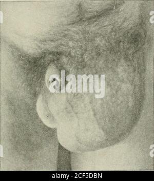 . Ernia addominale : diagnosi e trattamento. Uguale a abete. 50. Quattro settimane di funzionamento più aller per ernia labiale destra, inguinale. L'ernia sigmoidea e caecale può essere considerata correttamente sotto una voce a causa della loro somiglianza nelle conizioni anatomiche e nell'aspetto generale. La loro diagnosi è particolarmente-larly importante a causa delle difficoltà nel funzionare con successo e sicuro su loro e lo considero fortunato che iCan presenti parecchie fotografie eccellenti dei casi in cui la diagnosi è stata limitata all'operazione. Non è sempre possibile eseguire la diagnosi di questa condizione prima del funzionamento, come Foto Stock