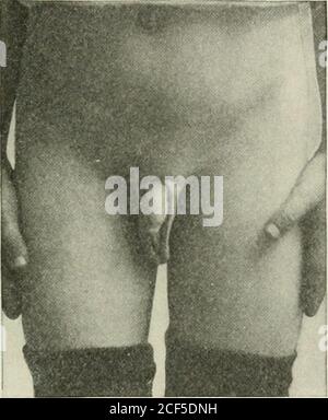 . Ernia addominale : diagnosi e trattamento. Stesso caso della Fig. 46, mostrante heniae venduto da capriate, che è stato indossato un anno prima dell'operazione per cura. alla dimensione del collo del tumore. Se diese herni;e havebectmie ery grande e sono di lunga durata, questo non tiene sempre vero. IMG. 44 mostra ernia congenita tipica asosservata nell'adulto. Confrontare con la fig. 49, che mostra ernia scrotale atipica della forma acquisita: fig. 50 mostra ernia labiale atipica nella femmina. Ernia inguinale obliqua, acquisita.- mentre la congenitalernia si presenterà sempre come una sporgenza scrotale, il Foto Stock