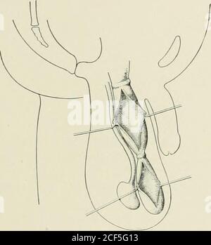 . Ernia addominale : la sua diagnosi e il suo trattamento. Erano confinati a sacche congenite e rappresentavano i punti di chiusura, o obliterazione, della tunica vaginalis, ma un'ulteriore osservazione mi ha convinto che sono morefrequenti in sacche della forma acquisita. Questi anelli sono sotugh che se un ciclo di viscere è spinto forzatamente in uno di loro, strangolamento è abbastanza sicuro per risultare. Di solito sur-round l'intero sacco, ma a volte solo una parte di esso, thebalance del sacco è sottile. Da uno a quattro possono essere fondate nello stesso sacco, situato in qualsiasi punto dalla vicinanza della H Foto Stock