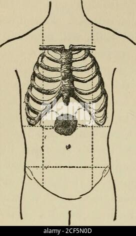 . Lezioni sulla diagnosi di tumori addominali, fornite alla classe post-laurea della Johns Hopkins University, 1893. n del fegato, della milza e di altre parti dell'addome è negativo. La diagnosi dell'aneurisma dell'addome 158 LA DIAGNOSI DEI TUMORI ADDOMINALI. L'aorta è stata fatta dal Dott. Hedetson, sotto la cui cura il paziente è venuto per primo, E poi, quando lo vidi, il dubbio sorse nella mia mente, a causa della mobilità estrema, se fosse veramente in aorta, o se non fosse collegatocon uno dei rami: Il tumorsembrava notevolmente mobile, e poteva essere spinto così lontano da sinistra Foto Stock