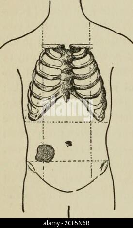 . Lezioni sulla diagnosi dei tumori addominali, consegnate alla classe post-laurea dell'Università Johns Hopkins, 1893. Pineof the ilium. Sembra molto superficiale; non è tenero; è molto duro; e uno o due creste possono essere avvertite su it.There non sono cambiamenti nella relativa consistence. Sulla profonda ispirazione discende leggermente. È liberamente mobile e canbe spinto sopra fino all'ombelico.Nessun gas è da sentire a bolla attraverso. Sulla percussione leggera c'è una timpanica piatta sopra di essa. Poiché il paziente aveva avuto pochissimi sjraptoms intestinali e dispepsia di Hadhad per parecchi anni, con recentemente due attacchi di Foto Stock