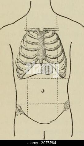 . Lezioni sulla diagnosi dei tumori addominali, consegnate alla classe post-laurea dell'Università Johns Hopkins, 1893. ble. La temperatura tra il 29 agosto e l'11 settembre non era superiore al normale. I sintomi dis-enterici erano migliorati veritimamente e dal 9 al 13 settembre aveva avuto solo uno o due gemelli al giorno. L'11 settembre ha fatto, per la prima volta, com-plaint di un dolore nella re-gione epigastrica, e ci era stato per due febbre di giorno, la temperatura aumentante a 100°. C'era un po 'di sensitivenessover il fegato nella linea centrale, il butthe organo non sembrava essere en Foto Stock