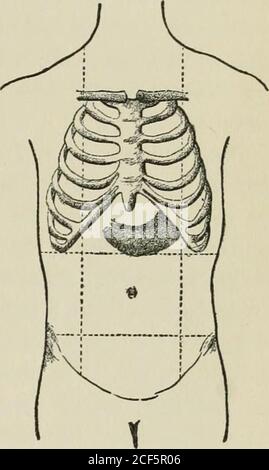 . Lezioni sulla diagnosi di tumori addominali, consegnate alla classe post-laurea dell'università Johns Hopkins, 1893. Una dieta ordinaria, ma, trovando thatit ha dato una buona dose di distress, wasreplaced da una dieta liquida di albu-min uovo e latte, che ha concordato molto bene.mentalmente era molto disprezzante. Il bismuto e la soda sono stati firstged un'ora o così dopo aver mangiato, edealleviarono prontamente il senso di oppressione. Non era pensieroso mentre per affliggerlo con i tentativi alla lavanda o prova i breakfasts. Il paziente ha lasciato l'ospedale senza migliorarlo il 19. Il paziente è morto il 28 settembre 1892. Caso XXI Foto Stock