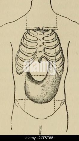 . Lezioni sulla diagnosi dei tumori addominali, consegnate alla classe post-laurea dell'Università Johns Hopkins, 1893. Fino a una settimana fa, quando ha iniziato a vomitare. Prima di questo si è smentito che l'addome era gonfio. Il vomito si è presentato soprattutto dopo aver assunto il cibo e non ha allevato grandezze. Condizione presente. - il paziente è sottile, ma l'emaciazione non è estrema. Le labbra e le mucose sono di un colore abbastanza buono. La linguetta è leggermente solforata con un rivestimento bianco. Pulseregular ; temperatura normale ; ghiandole superficiali non ingrossate. L'addome è prominente, in particolare in Foto Stock