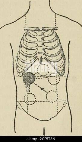 . Lezioni sulla diagnosi dei tumori addominali, consegnate alla classe post-laurea dell'Università Johns Hopkins, 1893. Agram, che era mads con grande cura, illustratesle varie posizioni che il massaggiante può essere fatto assumere. Può essere spinto nella regione ipochon-driaca destra, in modo da essere coperto al più completamente dalle costole, ed esami insuccessivi questa era notraramente la situazione in cui è stato trovato, e da cui si poteva solo dislocare dalla più profonda in-spirazione o da una profonda pressione nella regione terenale. La massa non è tenereven su pressione dura. Ci è sordo- Foto Stock