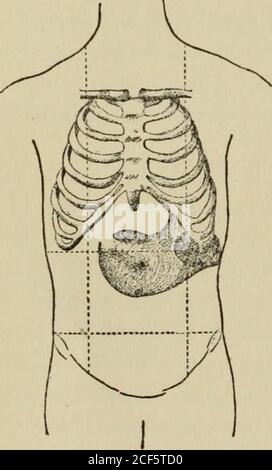 . Lezioni sulla diagnosi dei tumori addominali, consegnate alla classe post-laurea dell'Università Johns Hopkins, 1893. Line. Questa peristalsi durante il rigonfiamento occupa il quadrante sinistro e il quadrante superiore destro delle regioni ombelicali. Alla palpazione, l'addome è dappertutto morbido, molto resistente, a regolazione sotto la cartilagine ensiforme andover la preminenza sopra annotata.in quest'ultima la resistenza varia con la presenza o l'ascenza delle onde theperistaltiche. Immediatamente essere-basso la cartilagine ensiforme là isa definito cresta-come gonfiore whichis superficiale, molto tenero, e doesnot estendere intero Foto Stock