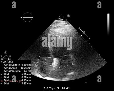 Immagine del cuore in modalità scala di grigi durante l'ecografia transesofagea. Foto Stock