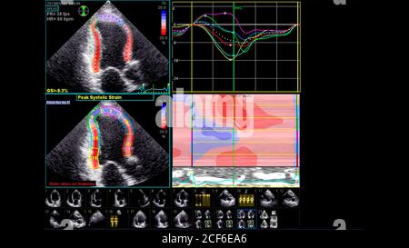 Immagine del cuore in modalità scala di grigi durante l'ecografia transesofagea. Foto Stock