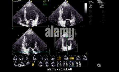 Immagine del cuore in modalità scala di grigi durante l'ecografia transesofagea. Foto Stock