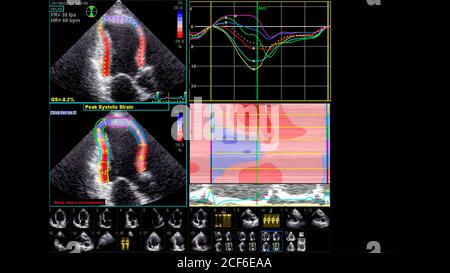 Immagine del cuore in modalità scala di grigi durante l'ecografia transesofagea. Foto Stock