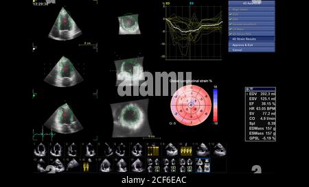 Immagine del cuore in modalità scala di grigi durante l'ecografia transesofagea. Foto Stock