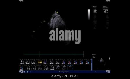 Immagine del cuore in modalità scala di grigi durante l'ecografia transesofagea. Foto Stock