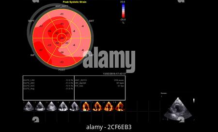 Immagine del cuore in modalità scala di grigi durante l'ecografia transesofagea. Foto Stock