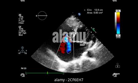 Immagine del cuore durante l'ecografia transesofagea con modalità Doppler. Foto Stock