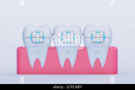 Tre denti con bretelle metalliche nella gengiva. Simboli di cura, ortodonzia e odontoiatria, rendering 3D Foto Stock