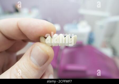 ponti dentali in ceramica metallica nelle mani di un medico Foto Stock