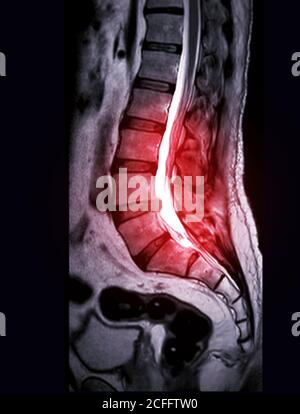 Messa a fuoco selettiva della tecnica RM L-S della colonna vertebrale o della colonna lamellare sagittale T2 per la diagnosi della compressione del midollo spinale. Foto Stock