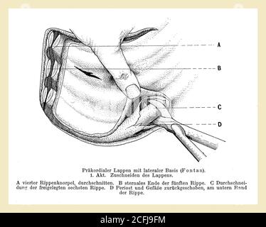 Sanità e medicina: Disegno che spiega come eseguire un taglio chirurgico del lobo precordiale con descrizioni tedesche Foto Stock