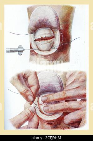 Sanità e medicina: Disegno che spiega come eseguire una sutura perirotulea Foto Stock