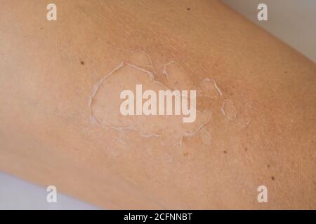 Primo piano dettaglio di una scottatura molto cattiva che mostra la pelle peeling di una schiena mans, protezione della pelle, cura della pelle in estate Foto Stock