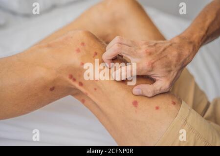 Gambe con molti macchia rossa e cicatrice da punture di insetto. Allergia alle zanzare. Morsi di mosca di sabbia Foto Stock