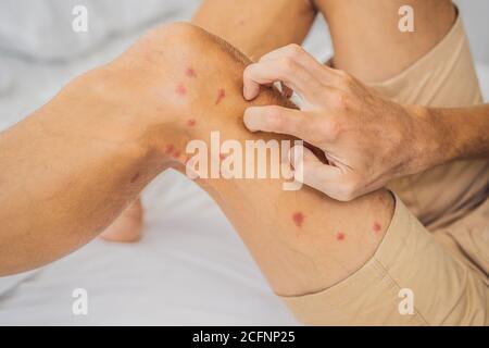 Gambe con molti macchia rossa e cicatrice da punture di insetto. Allergia alle zanzare. Morsi di mosca di sabbia Foto Stock
