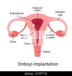 impianto. fase di gravidanza quando l'embrione aderisce alla parete dell'utero. Le parti dell'utero sono contrassegnate da linee. Illustrazione medica vettoriale. Illustrazione Vettoriale