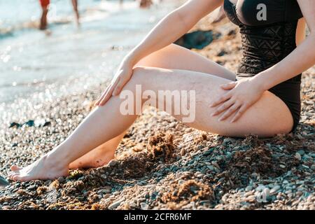 Varicosità. Una donna è seduta sulla spiaggia e mostra una maglia vascolare sull'anca. Primo piano delle gambe. Il mare è sullo sfondo. Foto Stock