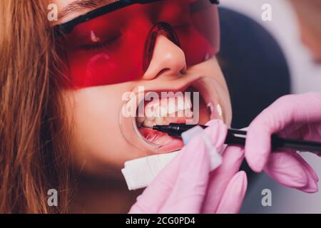 Il dentista confronta la tonalità dei denti del paziente con i campioni per il trattamento di candeggio. Foto Stock