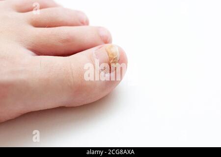 Primo piano di toenail con infezione da fungo Foto Stock