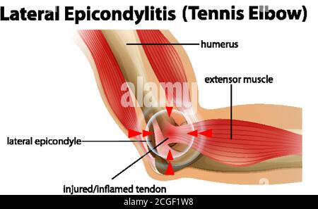 Illustrazione dell'epicondilite laterale o del gomito da tennis Illustrazione Vettoriale