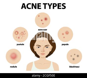 Tipi di acne sulla pelle o pimples illustrazione Illustrazione Vettoriale