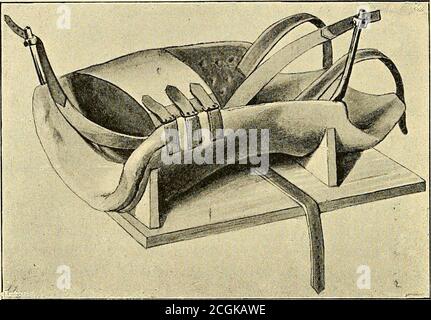. über die Unterscheidung einer habituellen und constitutionellen form derselben : eine kritische und klinische Studie . htreten. Unter Berücksichtigung des gleichen Gesichtspunktes wird dann dasganze Lagerungsbett innen wie aussen mit Tricot überzogen und denRändern mit dünnem Leder (am besten französischem sogenannten ge-spaltenem Schafleder) eingefasst. ALS Klebemittel dient Fischleim. 100 Therapie. Die so hergestellten Lagerungsbetten sind ausserordentlich leicht,äusserlich sehr gefällig und in jedes Bett einlegbar. Es empfiehlt si Foto Stock