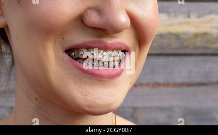 sistema a scrigno in bocca sorridente, macro denti foto, primo piano labbra, macro shot.