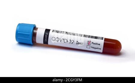 Test del coronavirus. Risultato positivo COVID-19 del campione di sangue nella provetta. Foto Stock