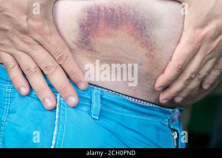 Livido, ematoma sul corpo umano. Grande livido, livido sullo stomaco di un uomo dopo la ferita Foto Stock