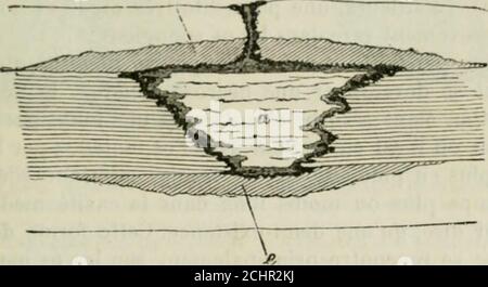 . Pathologie et thérapeutique chirurgicales générales . ., yï. Nécrose pnilielle ilan os lonfr. (Dessin scliomiiliquo.) dune mobilité anormale et dun relâchement concidérable, peut-être àcause de lallongement trop intense «les ligaments articulaires: cet état. Kig. 9:5. Figura 92 à une période ultérieure avci- néopUisie ossouse. (Uessin schématique.) nimplique ordinaidement pas daltération essentielle dans les fonctionsde lextrémité et il disparaît à la longue. Foto Stock