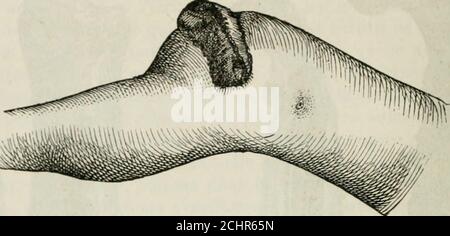 . Pathologie et thérapeutique chirurgicales générales . »il nostro remplacer complètement la perle de substance. Il peut encore arrier, comme dans un cas (fig. 90) de nécrose de lextré-mité inférieure de la diaphyse du fémur (clinique de Billroth), que le boutinférieur, détaché du cartilage épiphisaire appuie fortement contre la peau. Fig. 90. - Nécrose de la moitié inférieure de la diaphise du fémur, avec séparation du cartilageépiphisaire et perforation de la peau. Foto Stock