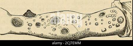 . I principi e la pratica della moderna chirurgia nei capitoli sono particolarmente dedicati agli organi tliosi. Le Kuuptions sifilitiche variano in grado dalla minima scoloritura alle ulcere più inveterate. 1. Nella forma più lieve, la pelle è la SIFILIDE SECONDARIA venosa. 199 e macchiati in macchie irregolari di colore rosso brunastro, che vengono ausate da un leggero rigonfiamento e da un'iniezione vascolare. Un grado maggiore dello stesso derangement produrrà psoriasi sifilitica, in cui la pelle è sollevata in blottes color rame, coperto da scale di ipertrofiedcuticola. O ci può essere un er Foto Stock